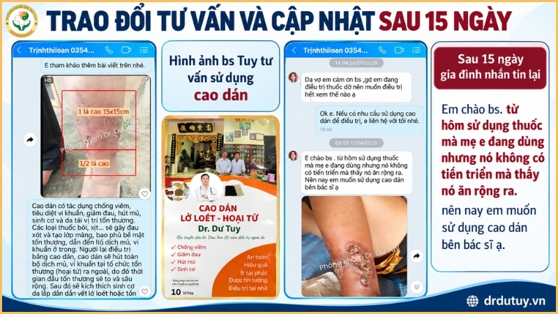tư vấn vết loét cập nhật 15 ngày