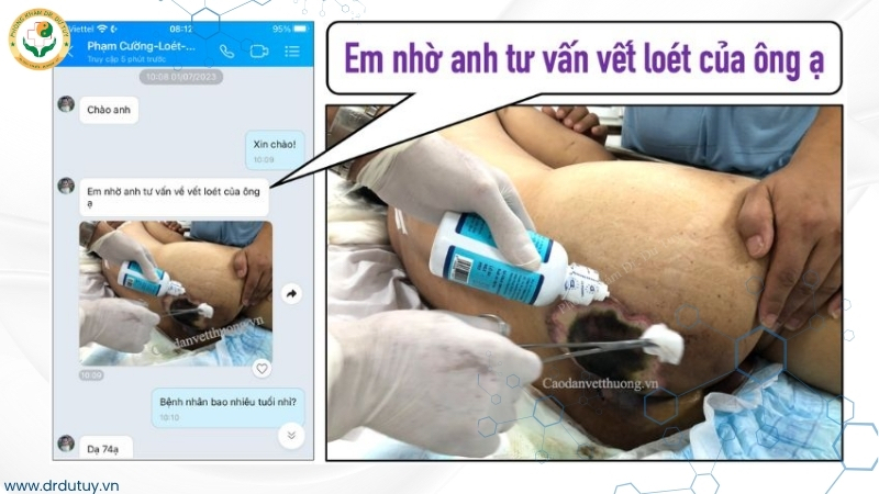 tư vấn loét vùng cùng cụt bệnh nhân 74 tuổi