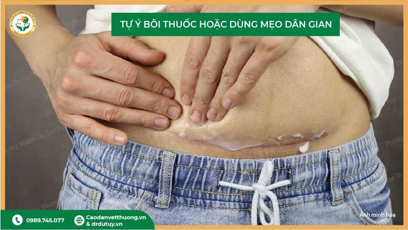 tự ý bôi thuốc mẹo dân gian khiến vết mổ nhiễm trùng