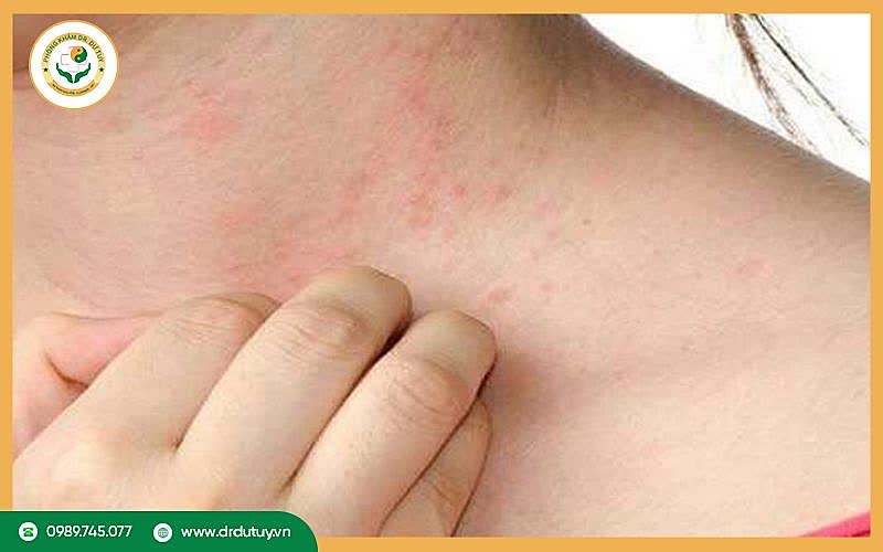 Ung thư da có ngứa không? Dấu hiệu, nguyên nhân và cách phòng ngừa