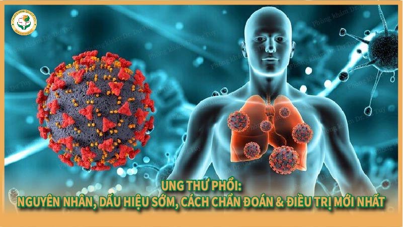 Ung thư phổi: Nguyên nhân, dấu hiệu sớm, cách chẩn đoán & điều trị mới nhất