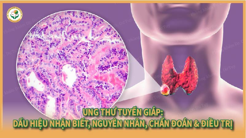 Ung thư tuyến giáp: Dấu hiệu nhận biết, nguyên nhân, chẩn đoán & điều trị