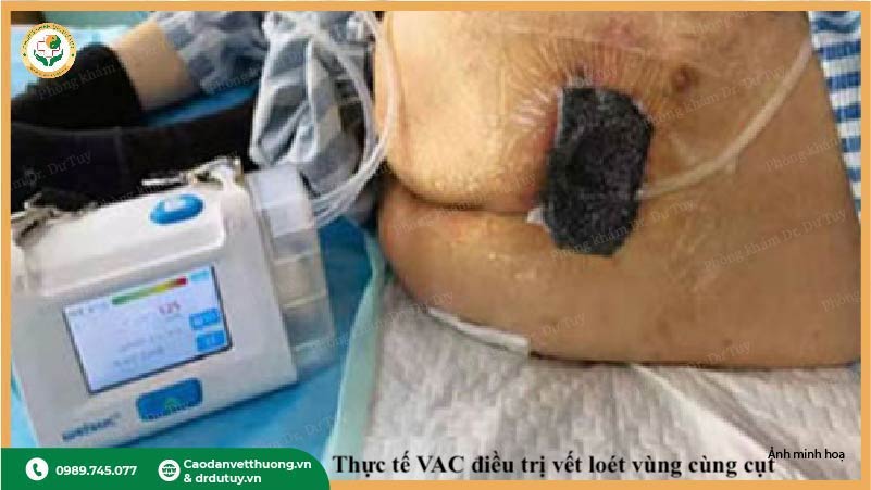 VAC điều trị vết loét tỳ đè người nằm lâu