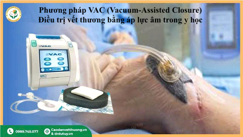 VAC điều trị vết thương áp lực âm