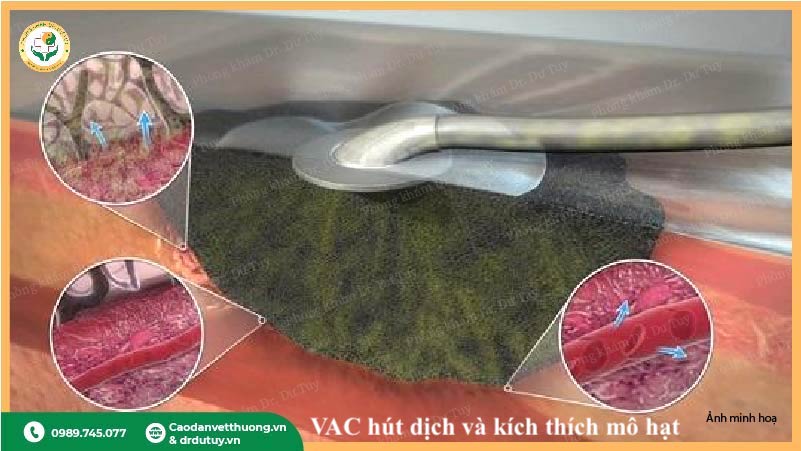 VAC hút dịch kích thích mô hạt vết thương