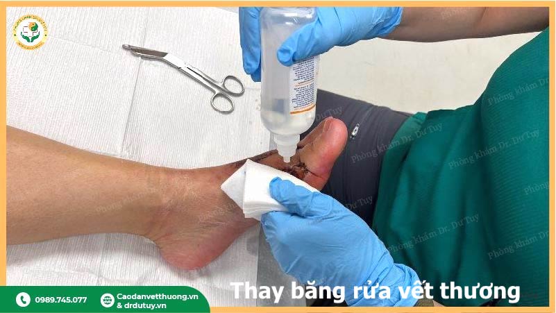 vệ sinh vết hoại tử ở bàn chân