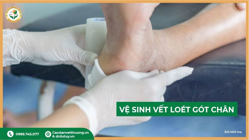 vệ sinh vết loét gót chân