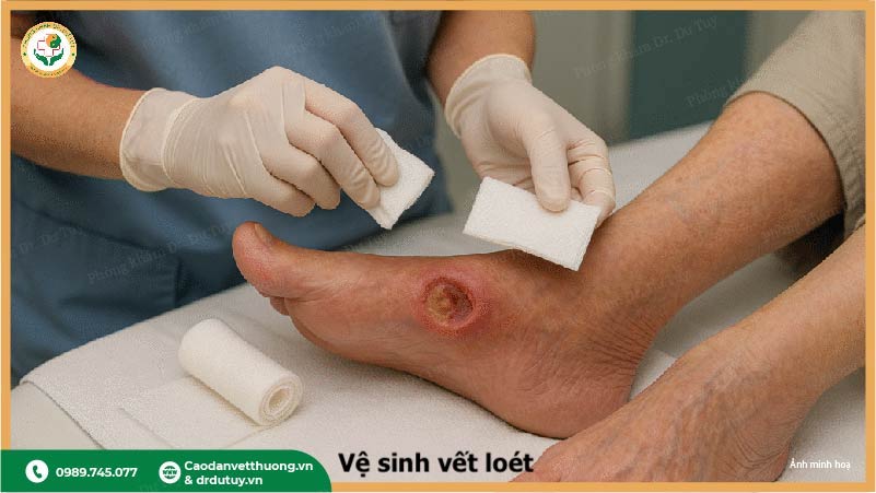 vệ sinh vết loét tì đè