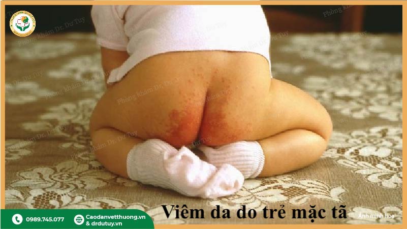 vệ sinh vùng tã cho bé