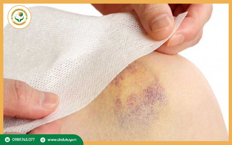Vết bầm vàng trên da có sao không? Có nguy hiểm không?
