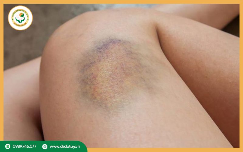 Nguyên nhân gây vết bầm vàng trên da