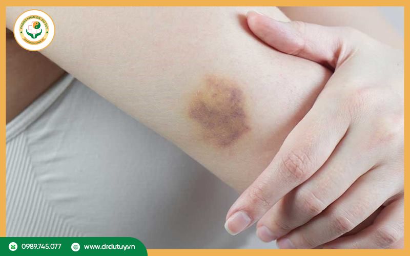 Nguyên nhân gây vết bầm vàng trên da