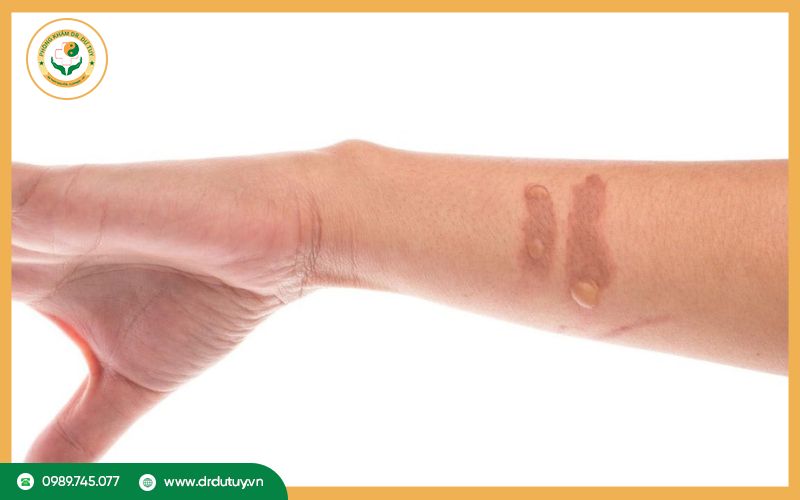 Vì sao vết bỏng bị thâm đen