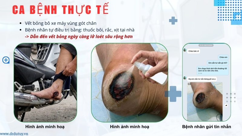 vết bỏng bô xe máy gót chân thực tế