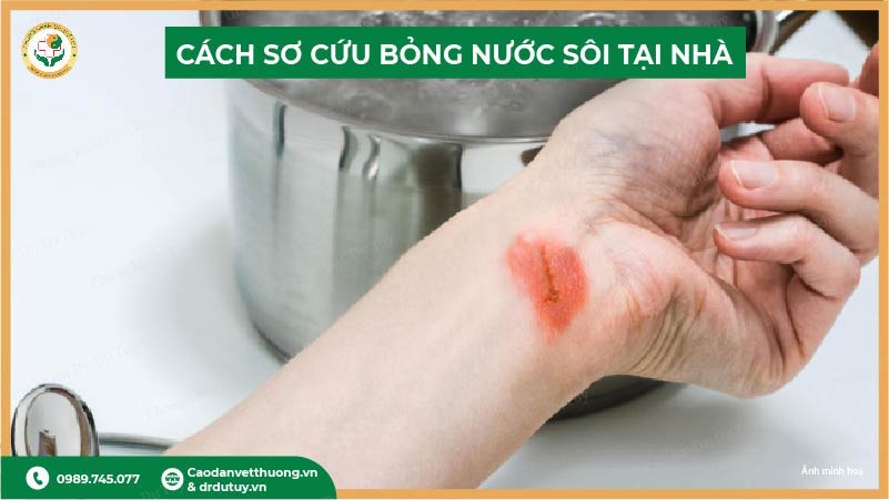 vết bỏng nước sôi thực tế