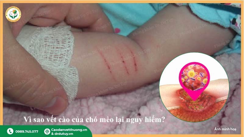 vết cào mèo ở tay trẻ nguy cơ nhiễm trùng
