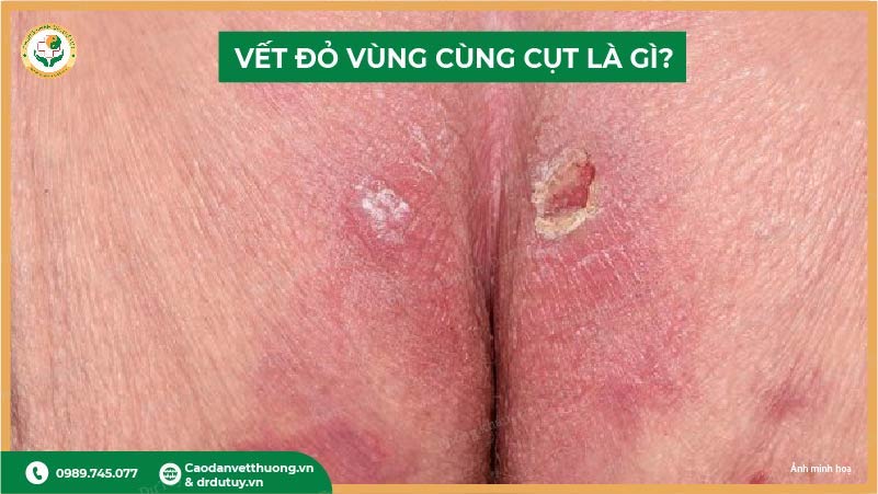 vết đỏ vùng cùng cụt là gì?