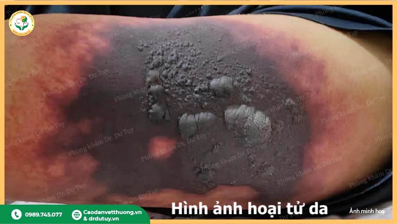 vết hoại tử da giai đoạn tiến triển màu đen