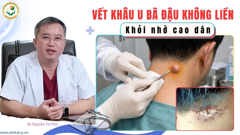 Vết khâu u bã đậu không liền: khỏi nhờ cao dán