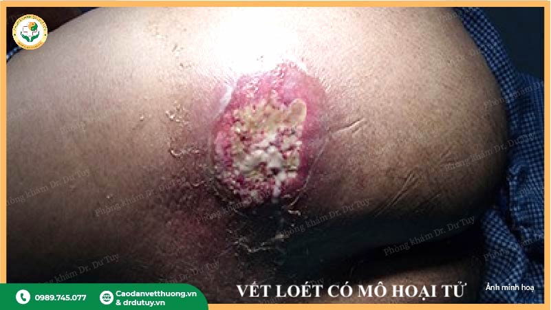 vết lở loét có mô hoại tử nguy hiểm