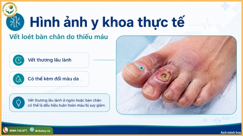 vết loét bàn chân do thiếu máu