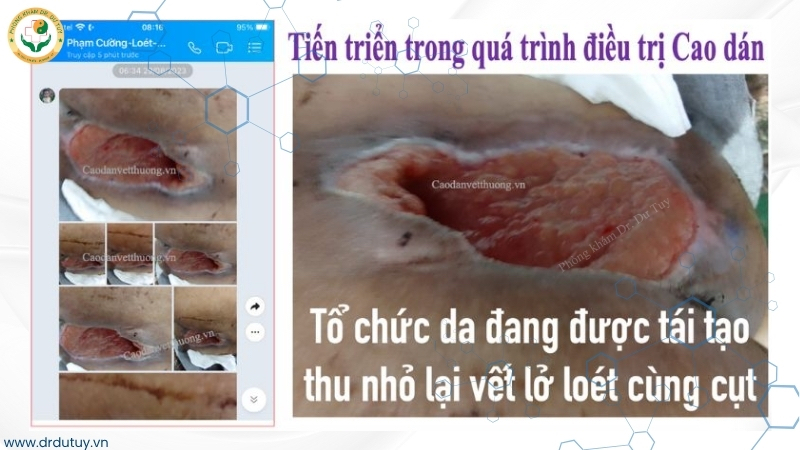 vết loét bắt đầu thu nhỏ tạo mô hạt