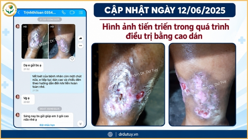 vết loét cẳng chân 12-06-2025