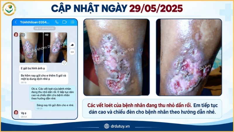 vết loét cẳng chân