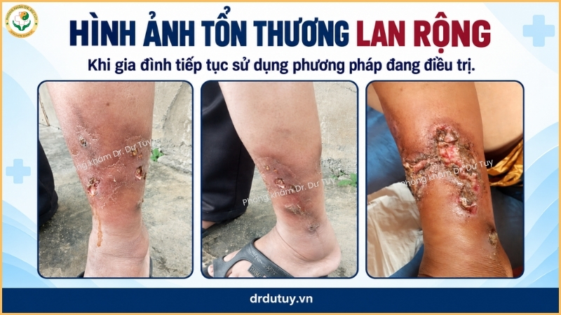 vết loét cẳng chân lan rộng