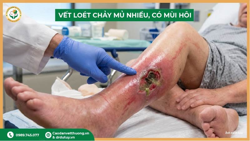 vết loét chảy mủ nhiều có mùi hôi