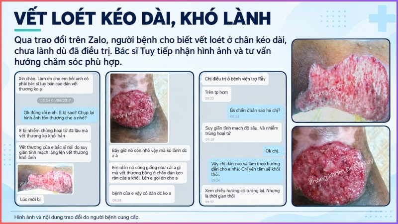 vết loét cổ chân kéo dài khó lành