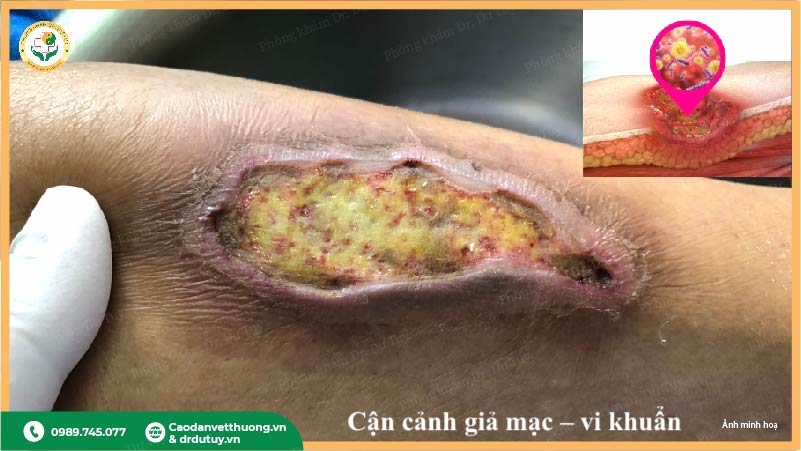 vết loét có giả mạc hoại tử