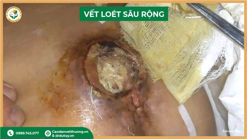 vết loét có mủ mùi hôi