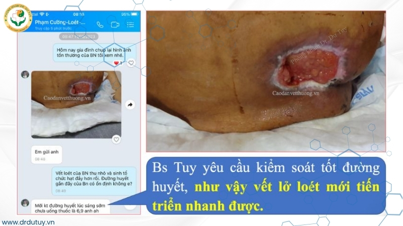 vết loét liền sẹo vùng cùng cụt