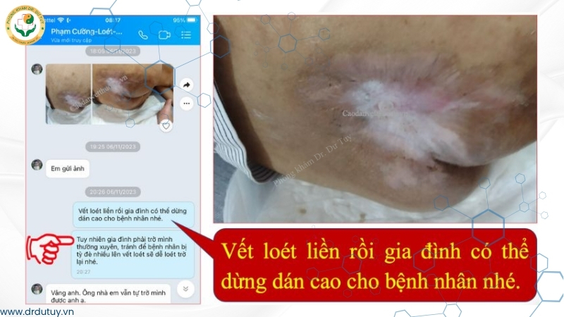 vết loét gần liền sau điều trị