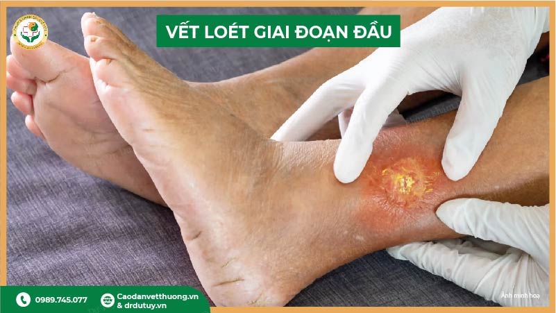 vết loét giai đoạn đầu