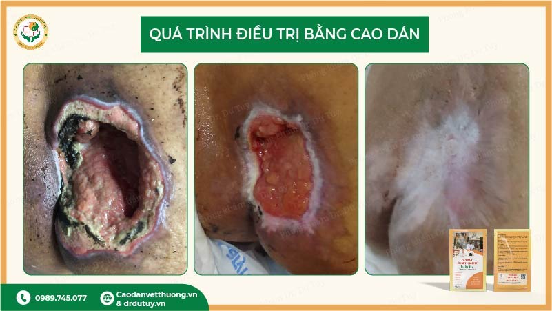 vết loét hồi phục thực tế