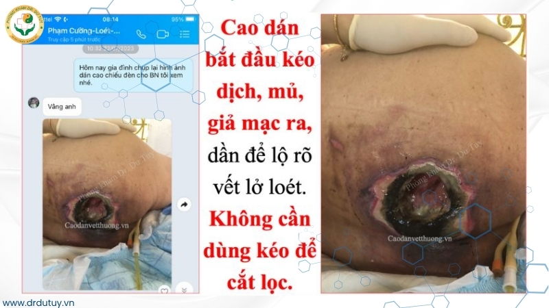 vết loét kéo mủ và loại bỏ giả mạc