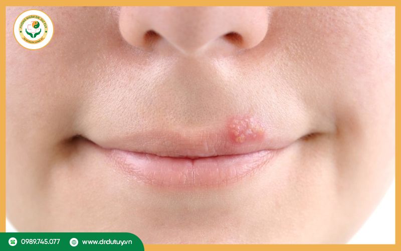 Vết loét lạnh là gì? Nguyên nhân, triệu chứng và cách chữa