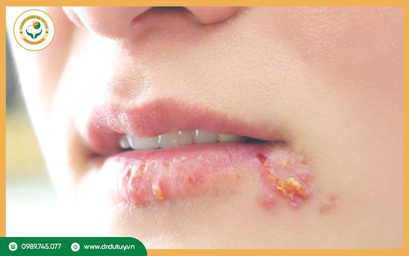 Triệu chứng của vết loét lạnh