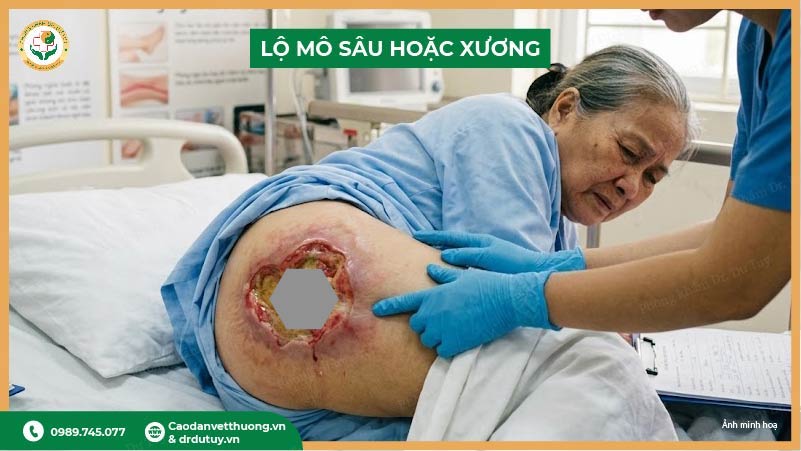 vết loét lộ mô sâu hoặc xương cần nhập viện