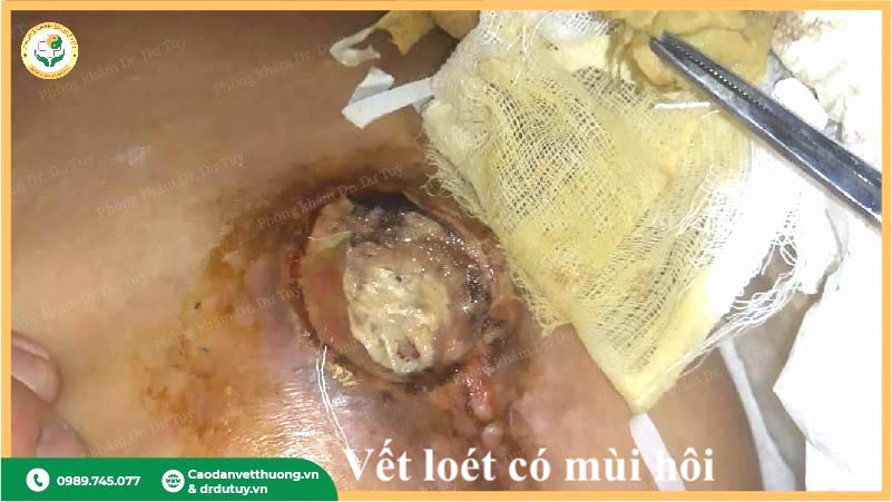 vết loét nhiễm trùng có mùi hôi mô hoại tử cần xử lý