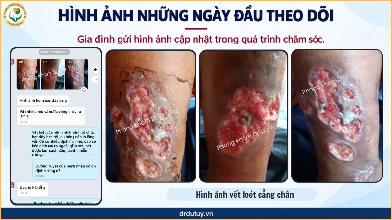 vết loét những ngày đầu theo dõi