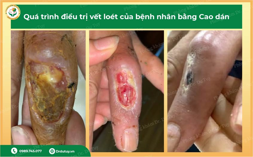 vết loét rắn cắn