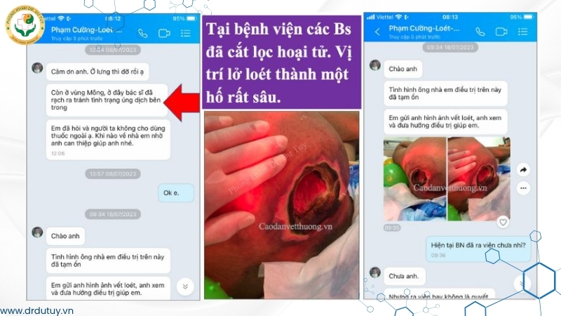 vết loét sâu sau cắt lọc hoại tử vùng cùng cụt