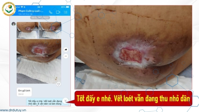 vết loét sau khi xử lý bắt đầu tái tạo