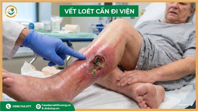 vết loét sâu nguy hiểm