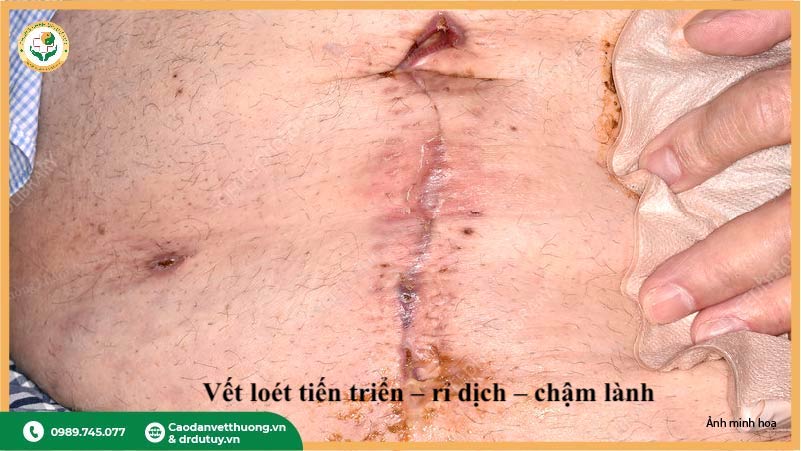 vết loét sau phẫu thuật chậm lành rỉ dịch