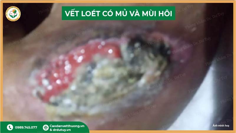 vết loét sưng đỏ
