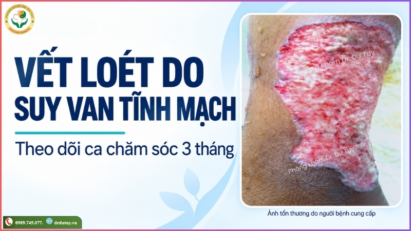 vết loét suy van tĩnh mạch theo dõi 3 tháng